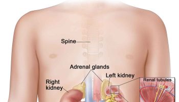 Pyelonephritis