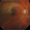 Retinal-artery-occlusion