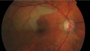 Retinal-artery-occlusion