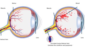 Retinal-vein-occlusion