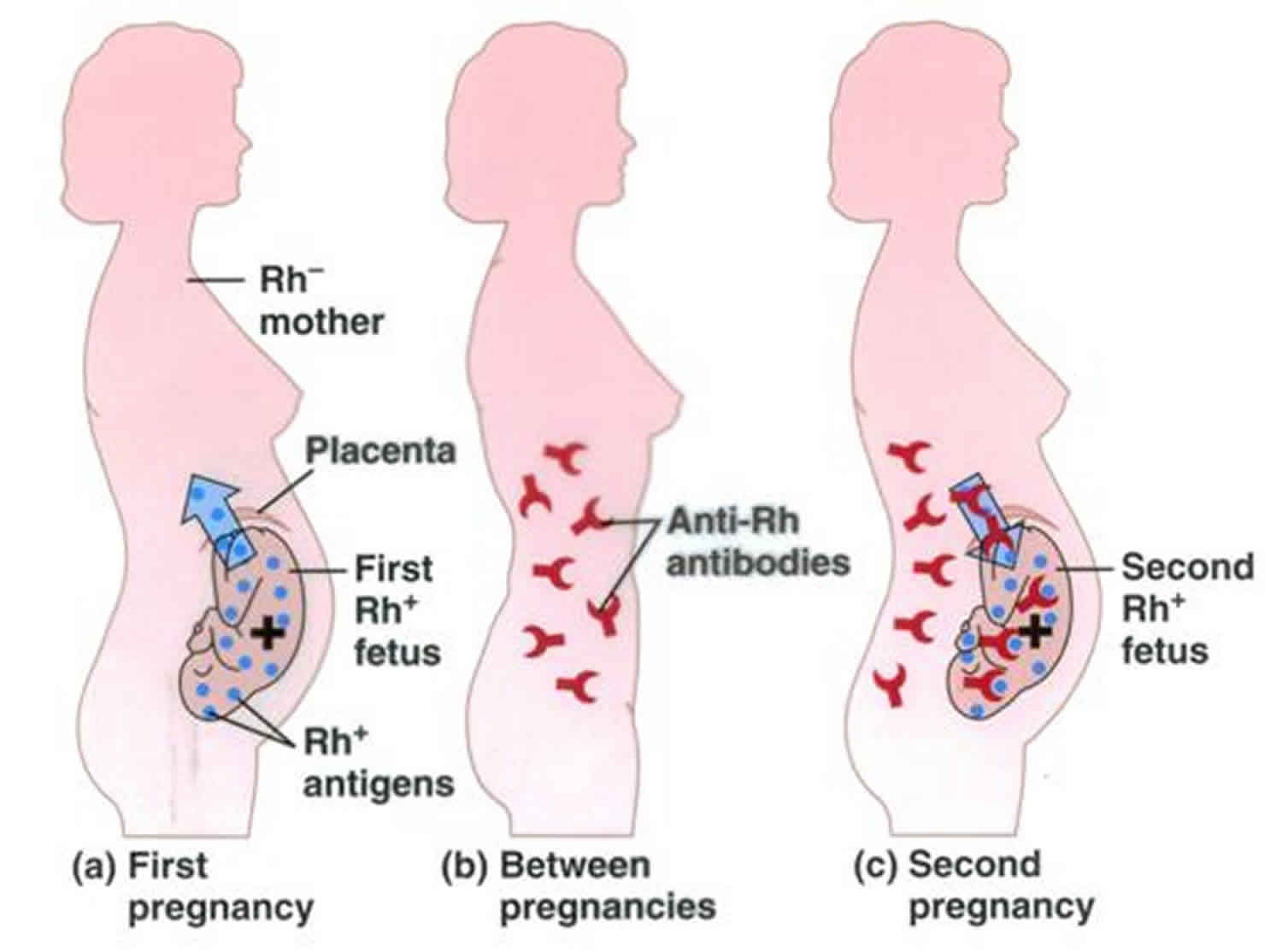 Rh Incompatibility Causes Symptoms Diagnosis Treatment