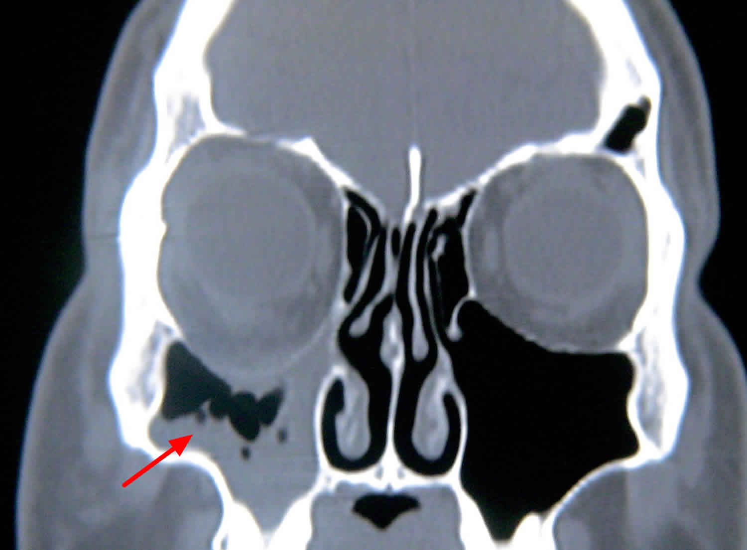 Silent sinus syndrome CT scan