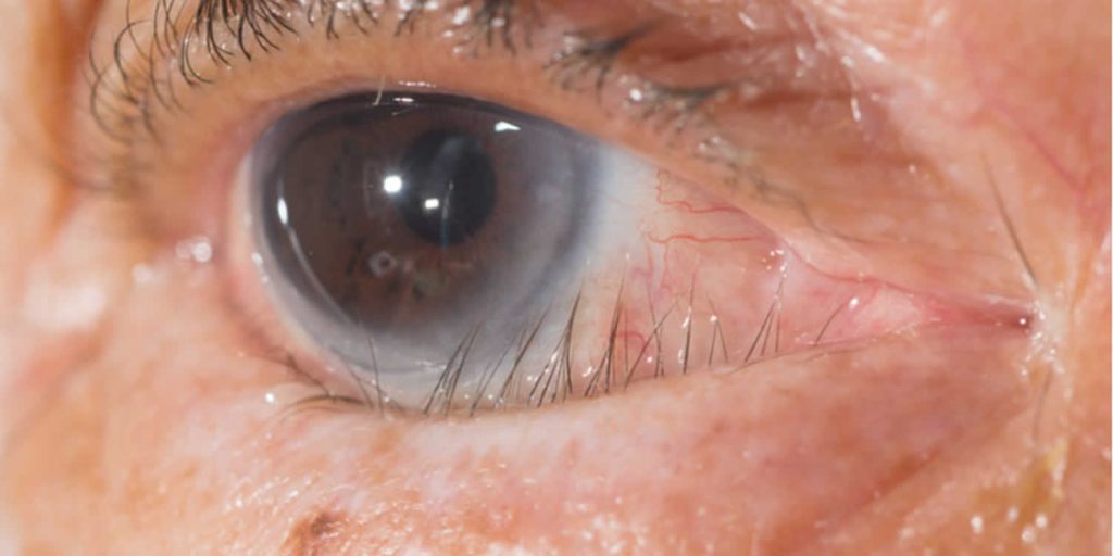 Trichiasis definition, causes, symptoms, diagnosis & treatment
