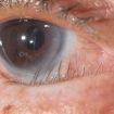 Trichiasis