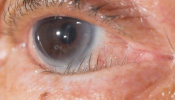 Trichiasis