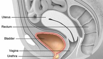 Urethral-diverticulum