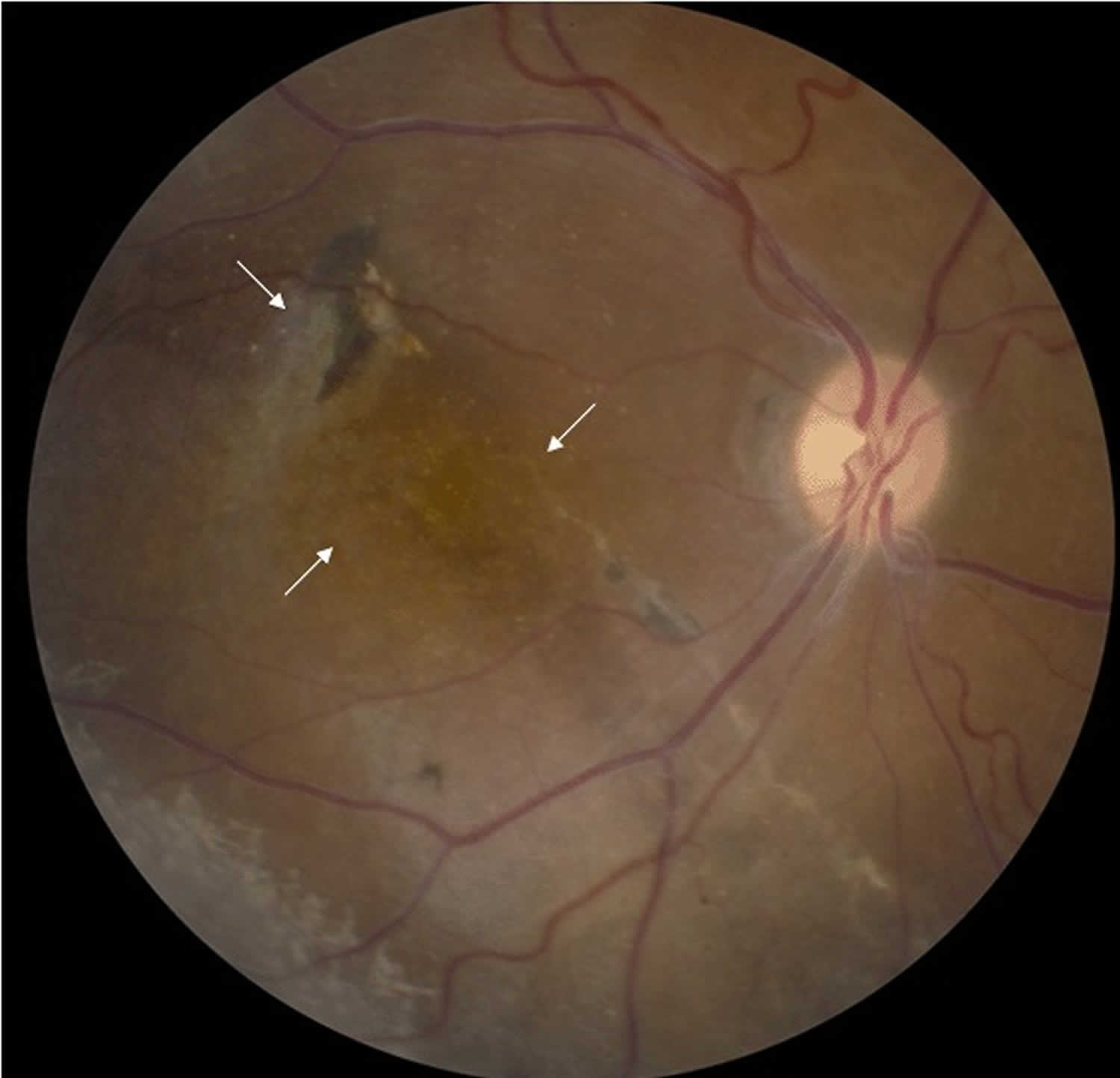 x-linked juvenile retinoschisis