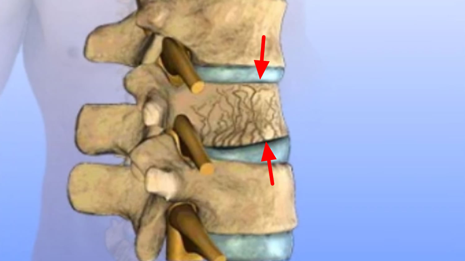 Compression fracture spine causes, symptoms, diagnosis & treatment