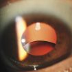 ectopia-lentis