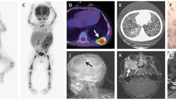 eosinophilic-granuloma