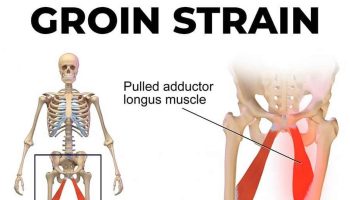 groin-strain