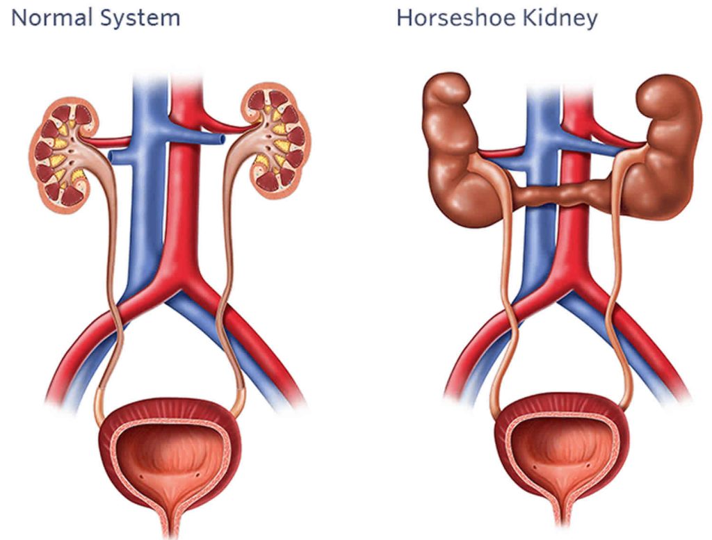 horseshoe-kidney-causes-symptoms-complications-diagnosis-treatment