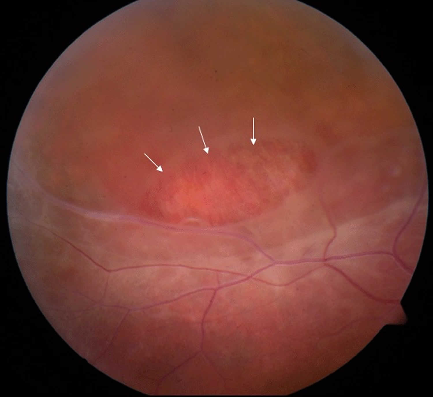 Juvenile retinoschisis