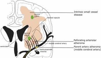 lacunar-stroke