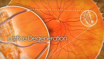 lattice-degeneration-of-retina