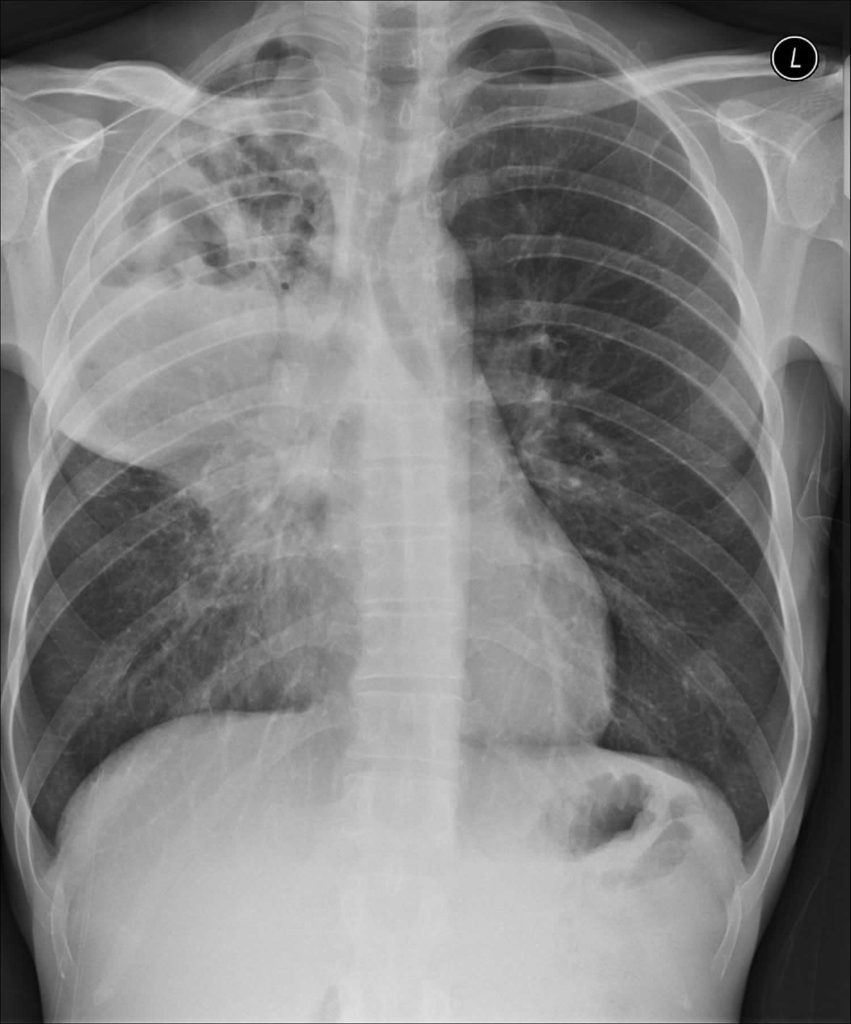 Lung abscess definition, causes, symptoms, diagnosis & treatment