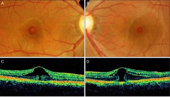 macular-hole