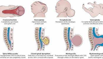 neural-tube-defects