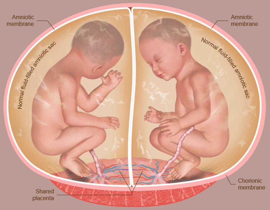 Twin To Twin Transfusion Syndrome Causes Symptoms Diagnosis   Normal Diamniotic Twins 1024x794 