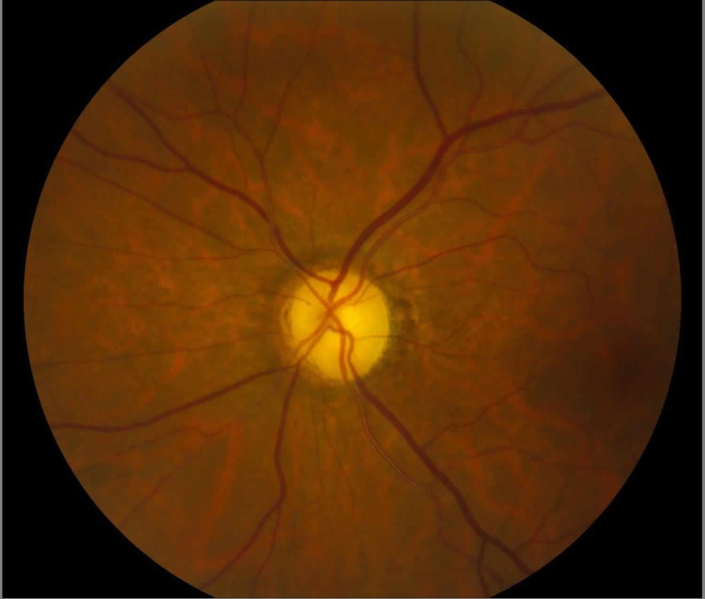 Optic nerve atrophy causes, symptoms, diagnosis & treatment