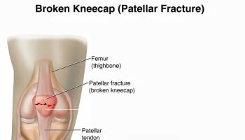 Patella fracture