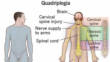 quadriplegia