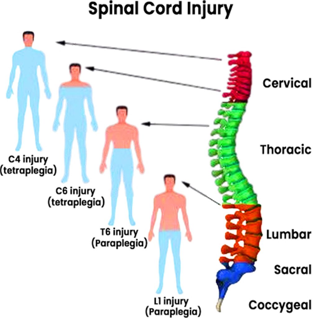 quadriplegia-or-tetraplegia-meaning-causes-symptoms-diagnosis