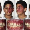 Sturge Weber syndrome
