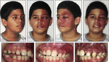 Sturge Weber syndrome