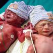 Twin to twin transfusion syndrome