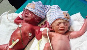 Twin to twin transfusion syndrome