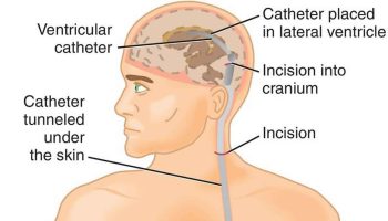 ventriculoperitoneal-shunt