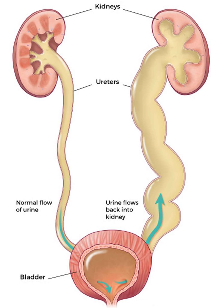 Vesicoureteral reflux causes, grading, symptoms, diagnosis & treatment