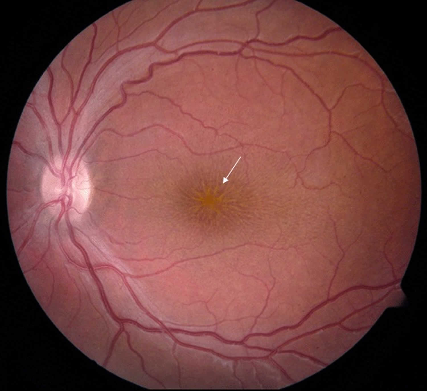 X-linked juvenile retinoschisis