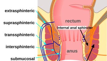 Anal fistula