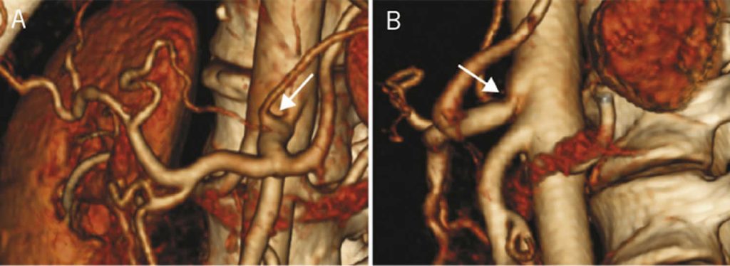 Celiac artery compression syndrome, causes, symptoms, diagnosis ...