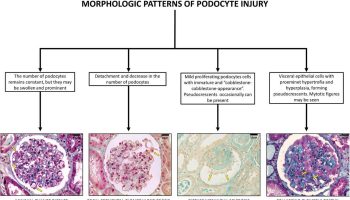 Collapsing glomerulopathy