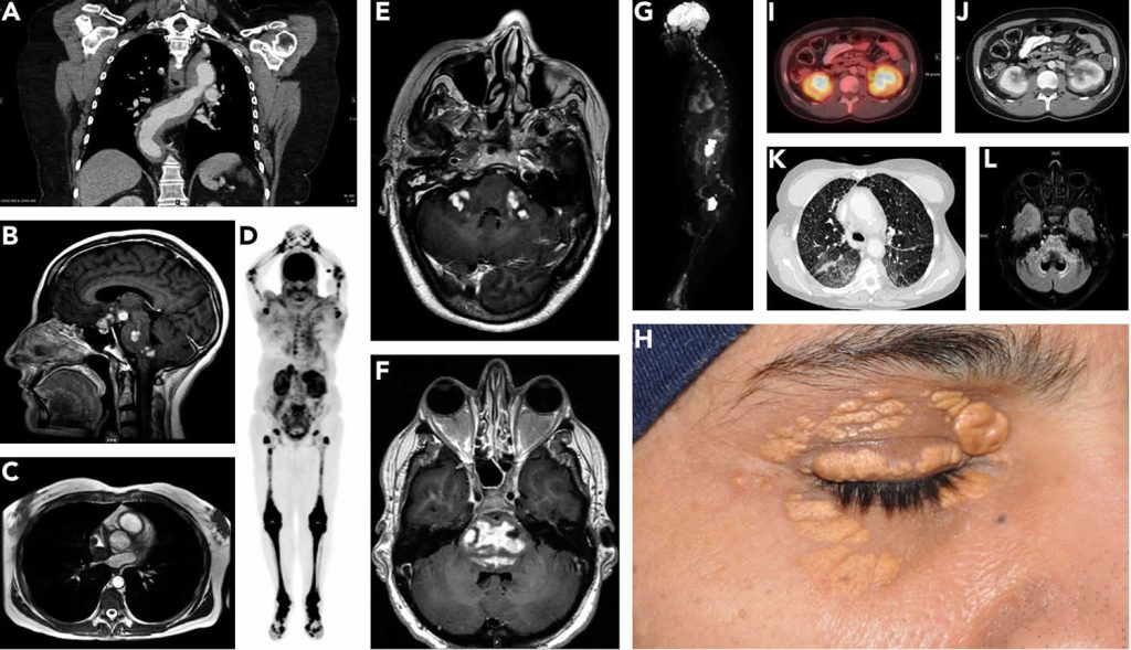 Erdheimchester Disease Causes Symptoms Diagnosis Treatment And Prognosis 