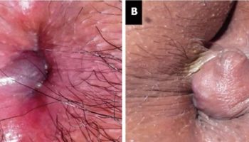 Perianal hematoma