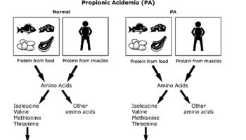 Propionic-acidemia