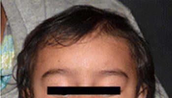 Rosai Dorfman Disease in an Infant