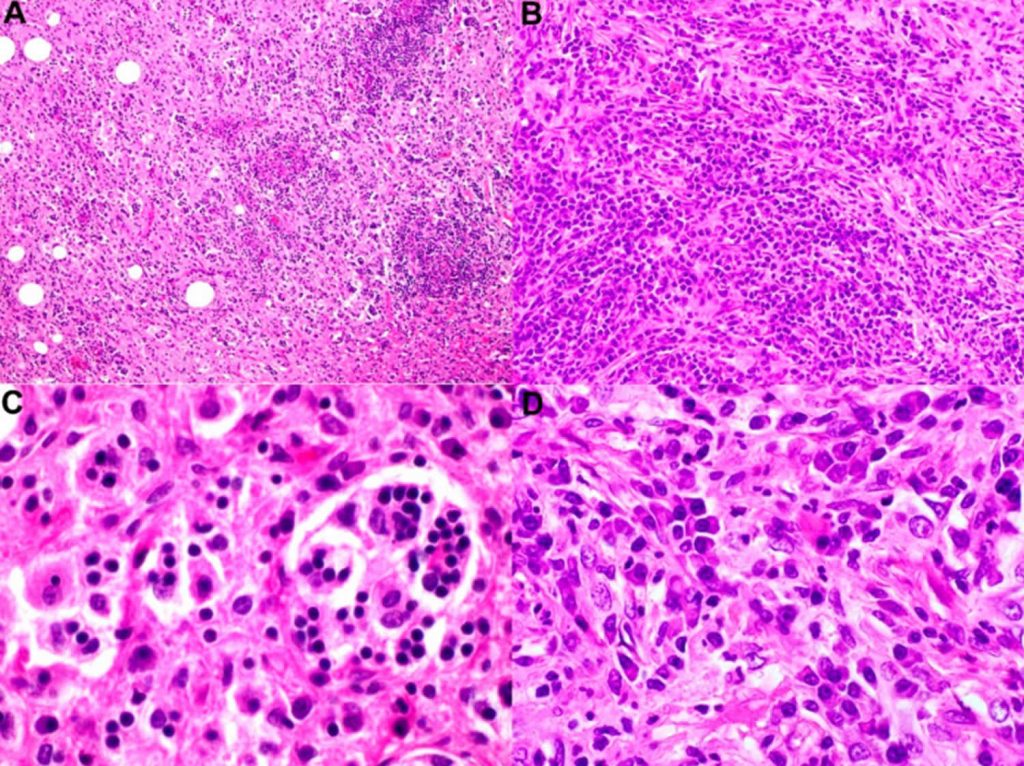 Rosai Dorfman Disease Causes Symptoms Diagnosis Treatment And Prognosis