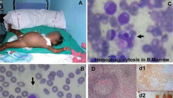 Secondary hemophagocytic lymphohistiocytosis