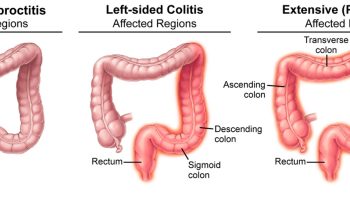 Ulcerative proctitis