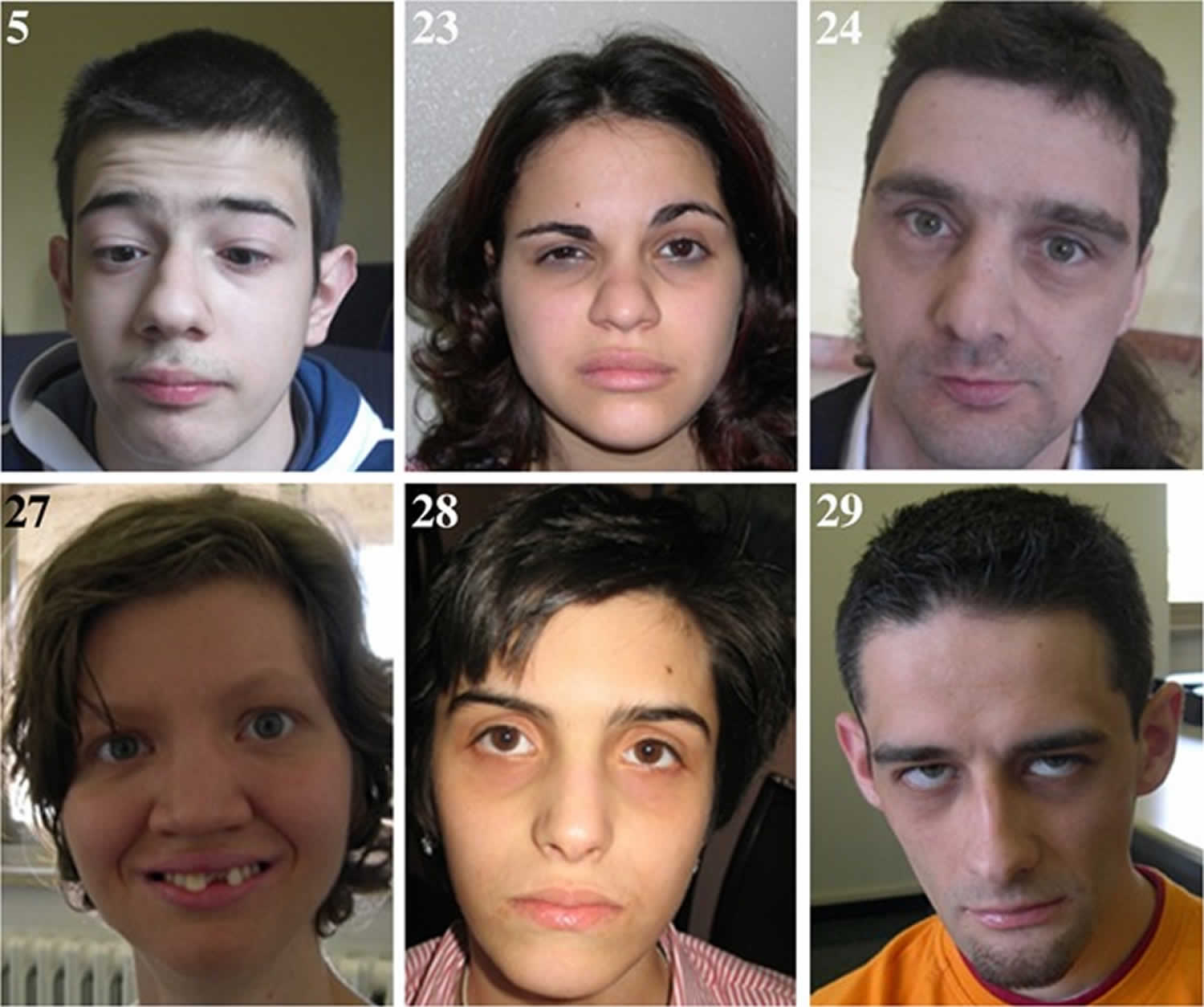 Alternating hemiplegia of childhood facial appearance in adults
