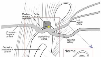 celiac artery compression syndrome