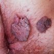 genital warts