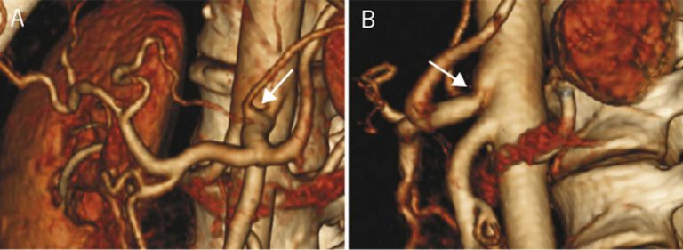 Median arcuate ligament syndrome, causes, symptoms, diagnosis ...