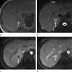 Bacillary peliosis