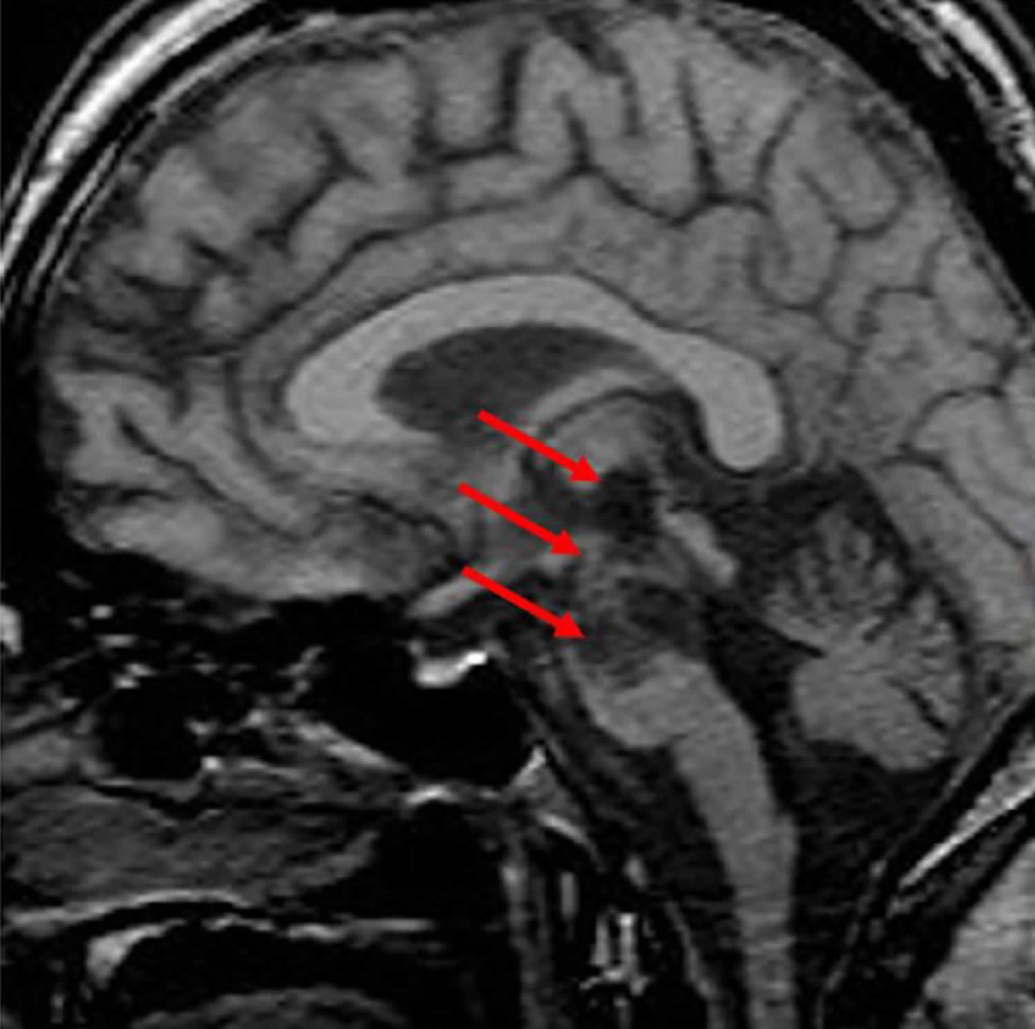 Locked-in Plus Syndrome MRI